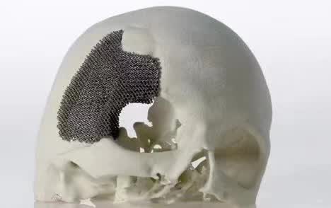 顱骨3D打印技術(shù)是什么？